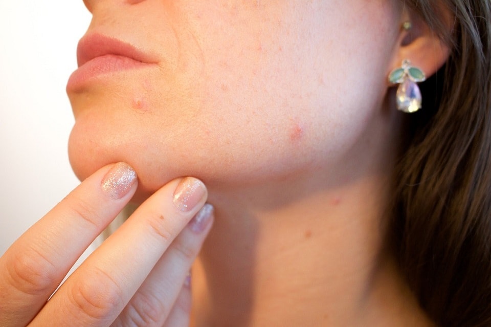 cbd for acne scars