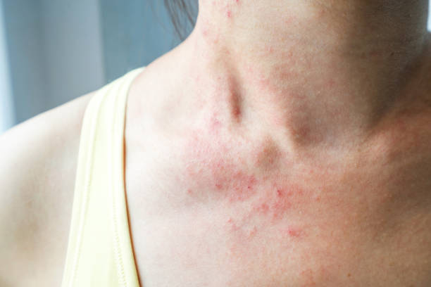 What is Eczema
